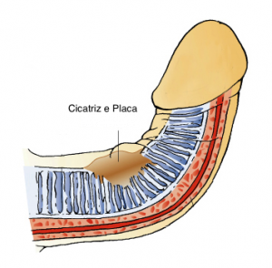 Pênis curvatura